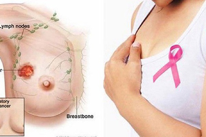 Triệu chứng ung thư vú giai đoạn đầu