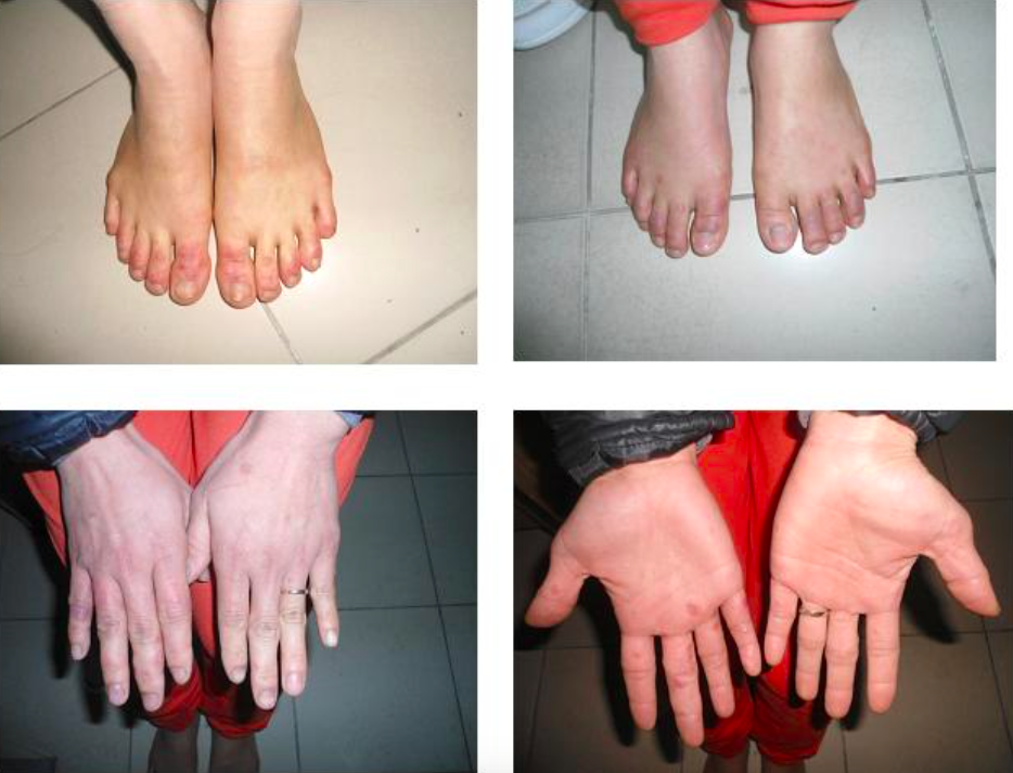 Bệnh cước ở ngón tay và ngón chân vào mùa đông xử trí ra sao?
